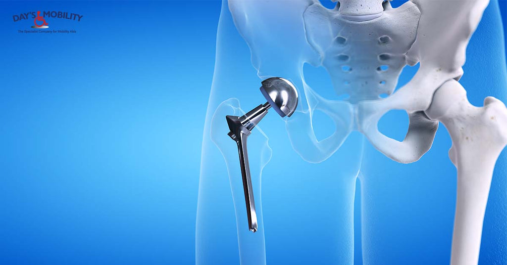 What are 6 Practical Tips for a Successful Hip Replacement Recovery?